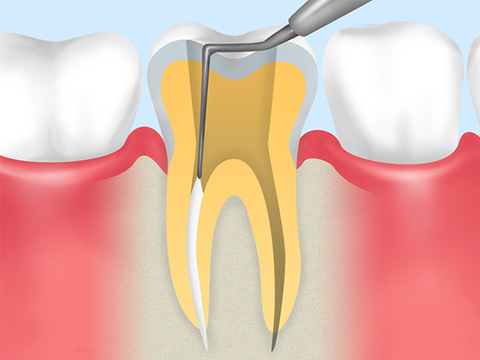 根管治療とは？