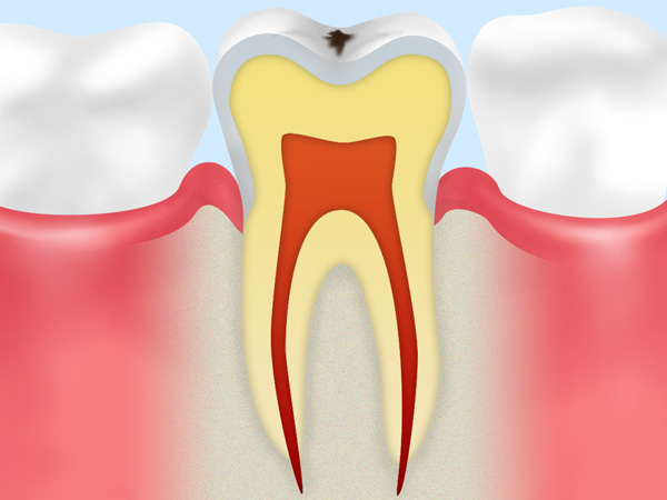 発生して間もない虫歯