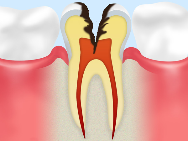 神経にまで達した虫歯