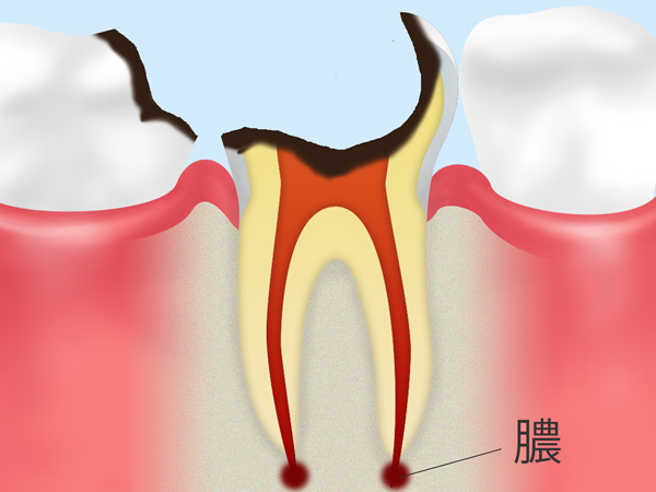 歯冠が崩壊した虫歯