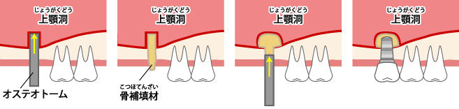 ソケットリフト