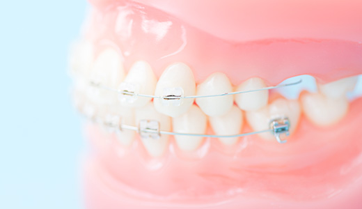 綺麗な歯並びを手に入れる矯正治療
